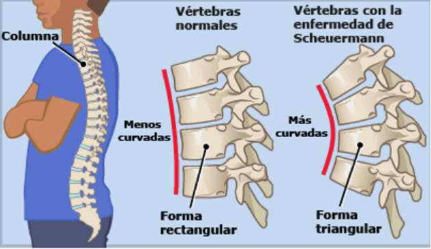 Encuyament dorsal de tres vertebres consecutives