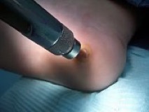 aplicació bleomicina berruga plantar