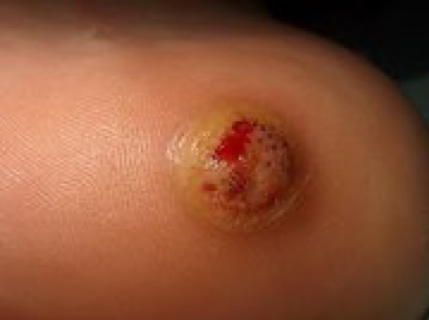 aspecte a les 48 hores de l'aplicació bleomicina berruga plantar