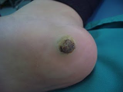 Aspecte als 10 dies del tractament berruga plantar