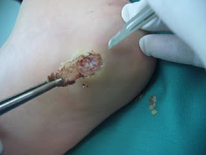 exeresi de la berruga plantar