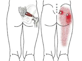 Síndrome del piramidal