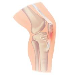Tendinitis rotuliana