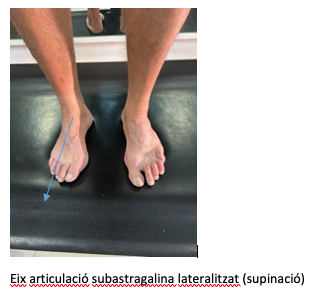 Eix articulació subastragalina lateralitzat (supinació)