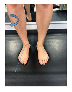 Lateralización del eje de la substragalina en el pie derecho con una rotacion tibial externa