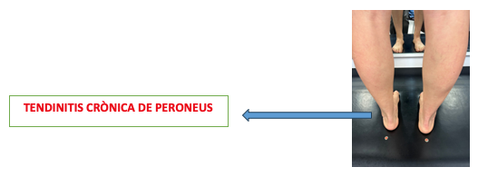 tendinitis cronica peroneus