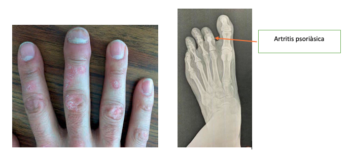 Artritis psoriàsica