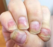 Pitting psoriàsic Pitting psoriàsic