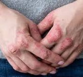 Psoriasi a la mà Psoriasi a la mà