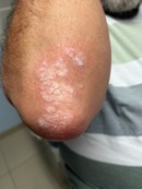 Psoriasi al colze Psoriasi al colze